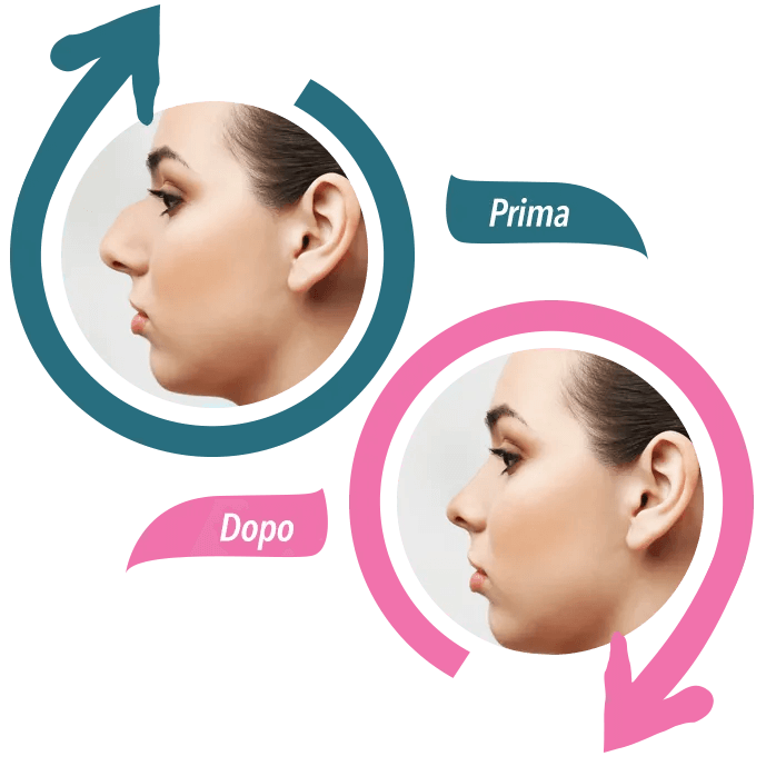 correzione nasale con rhino correct