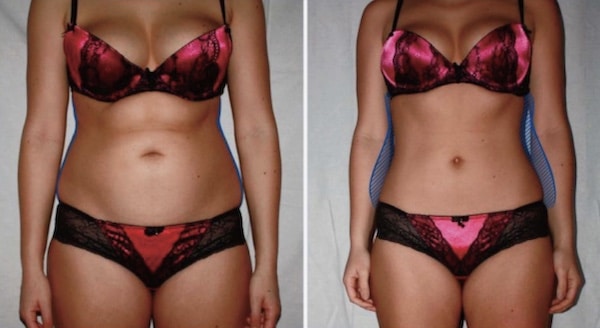 donna prima e dopo perdita di peso