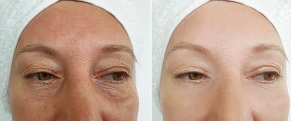 foto testimonianza utilizzo crema per le righe